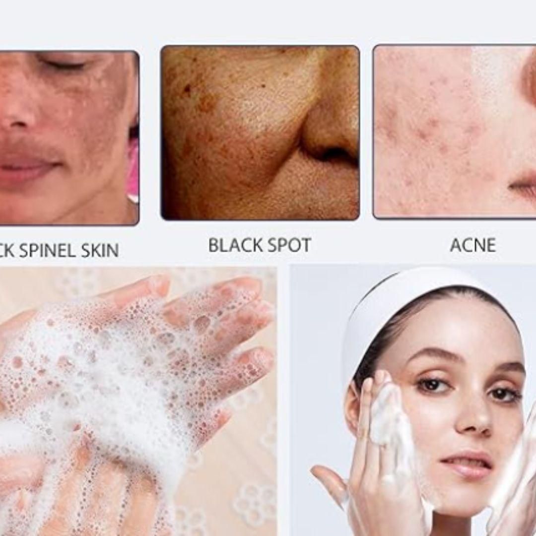 Lucacci For Accne Spot Cleansing Lotion 50Ml (Pack of 2)