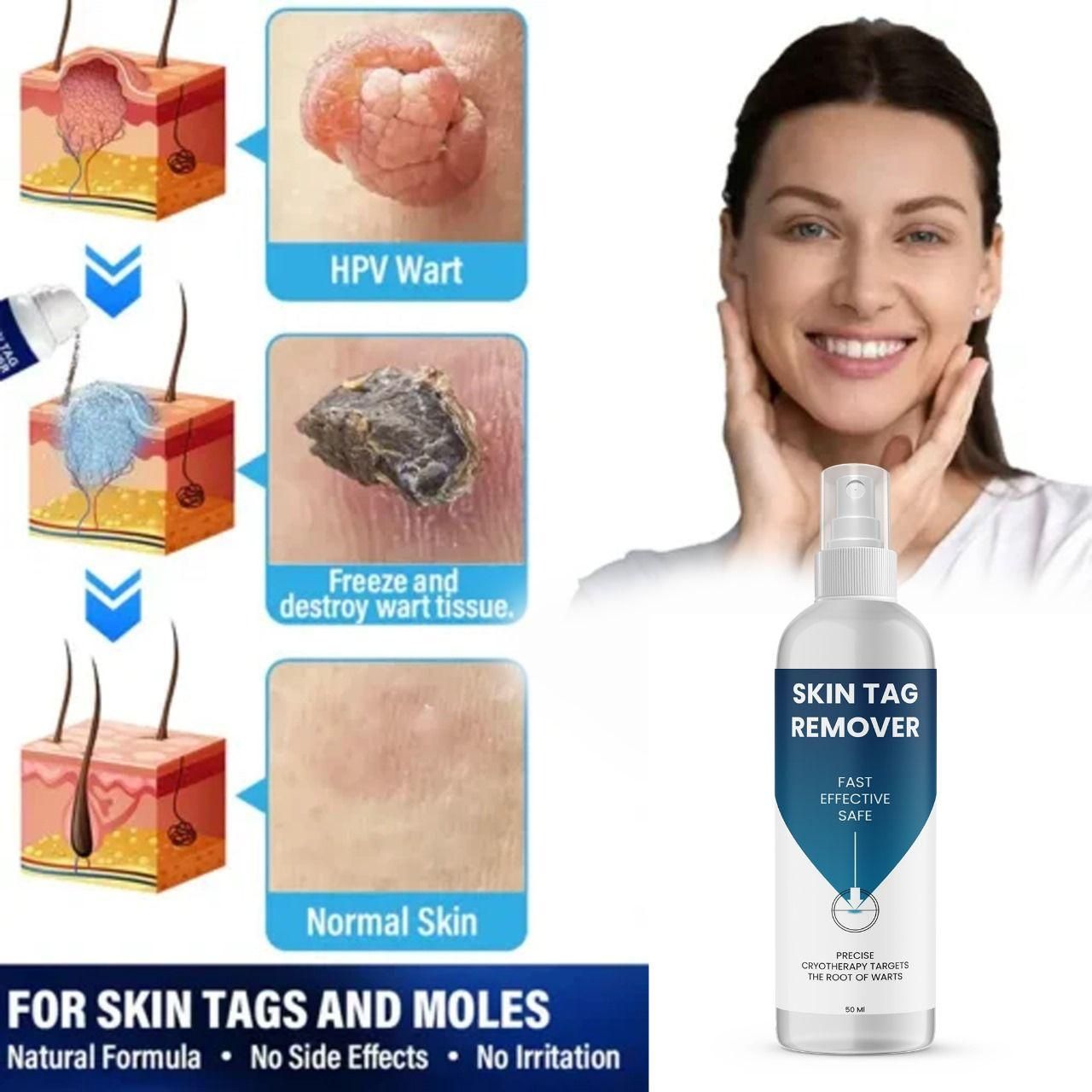 Skin Tag Remover 50 ml Pack of 1