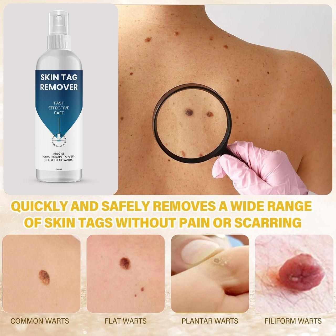 Skin Tag Remover 50 ml Pack of 1