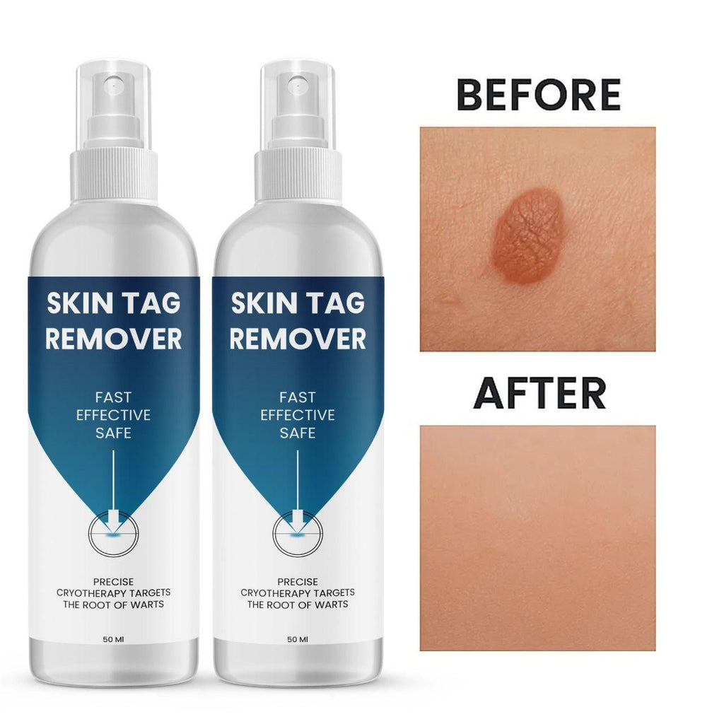 Skin Tag Remover 50 ml Pack of 1